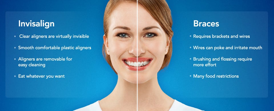 How Often Should You Change Invisalign® Aligners?