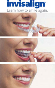 Invisalign Clear Braces San Rafael CA